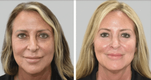, Services – Wrinkle Reducers