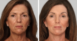 , Services – Wrinkle Reducers